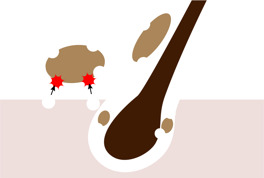 汚れを浮かして髪から剥がし気泡がぶつかる衝撃ではじき飛ばす。